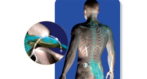 The implanted device sends mild electrical pulses to leads located near the spinal cord, interrupting the pain signals as they travel to the brain. . St jude neurostimulator model 3660